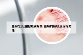 腿癣怎么治能彻底除根 腿癣的症状及治疗方法