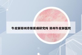 牛皮鲜郑州市银屑病研究所 郑州牛皮鲜医院