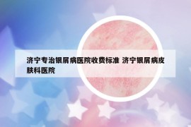 济宁专治银屑病医院收费标准 济宁银屑病皮肤科医院