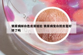 银屑病掉白色皮屑尴尬 银屑病变白脱皮是好转了吗