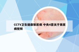 CCTV卫生健康银屑病 中央4套关于银屑病视频