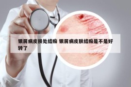 银屑病皮损处结痂 银屑病皮肤结痂是不是好转了