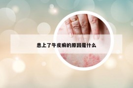 患上了牛皮癣的原因是什么