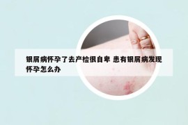 银屑病怀孕了去产检很自卑 患有银屑病发现怀孕怎么办