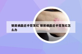 银屑病最近手臂发红 银屑病最近手臂发红怎么办