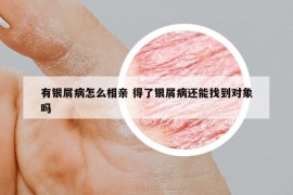 有银屑病怎么相亲 得了银屑病还能找到对象吗
