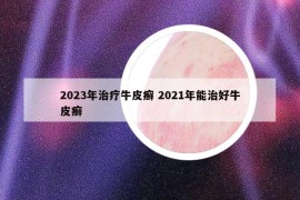 2023年治疗牛皮癣 2021年能治好牛皮癣
