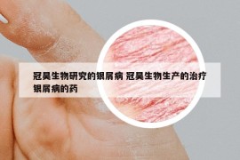 冠昊生物研究的银屑病 冠昊生物生产的治疗银屑病的药