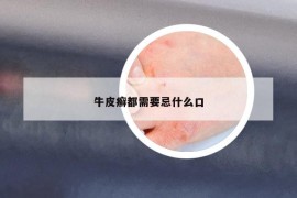 牛皮癣都需要忌什么口