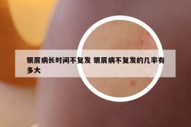 银屑病长时间不复发 银屑病不复发的几率有多大