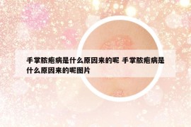 手掌脓疱病是什么原因来的呢 手掌脓疱病是什么原因来的呢图片
