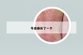 牛皮癣长了一个