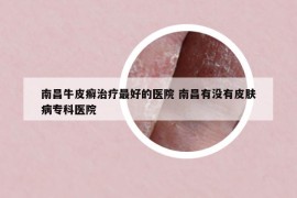 南昌牛皮癣治疗最好的医院 南昌有没有皮肤病专科医院