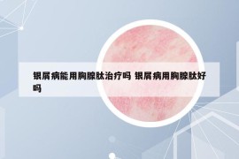 银屑病能用胸腺肽治疗吗 银屑病用胸腺肽好吗