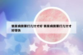 银屑病需要打几针才好 银屑病需要打几针才好得快