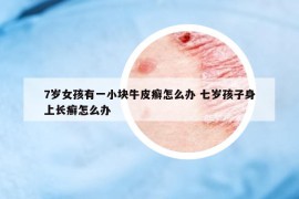 7岁女孩有一小块牛皮癣怎么办 七岁孩子身上长癣怎么办