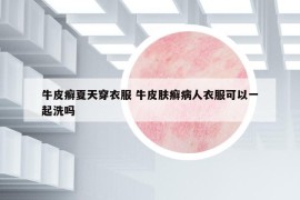 牛皮癣夏天穿衣服 牛皮肤癣病人衣服可以一起洗吗
