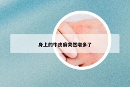 身上的牛皮癣突然增多了