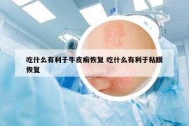 吃什么有利于牛皮癣恢复 吃什么有利于粘膜恢复