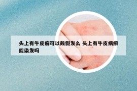 头上有牛皮癣可以戴假发么 头上有牛皮病癣能染发吗