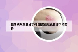 银屑病灰色算好了吗 银屑病灰色算好了吗图片