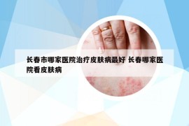 长春市哪家医院治疗皮肤病最好 长春哪家医院看皮肤病