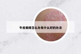 牛皮癣痒怎么办有什么好的办法