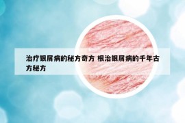 治疗银屑病的秘方奇方 根治银屑病的千年古方秘方