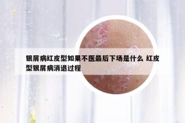 银屑病红皮型如果不医最后下场是什么 红皮型银屑病消退过程