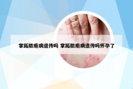 掌跖脓疱病遗传吗 掌跖脓疱病遗传吗怀孕了