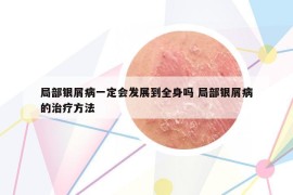 局部银屑病一定会发展到全身吗 局部银屑病的治疗方法