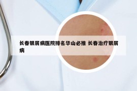 长春银屑病医院排名华山必推 长春治疗银屑病