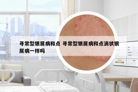 寻常型银屑病和点 寻常型银屑病和点滴状银屑病一样吗