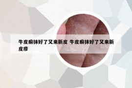 牛皮癣抹好了又来新皮 牛皮癣抹好了又来新皮疹
