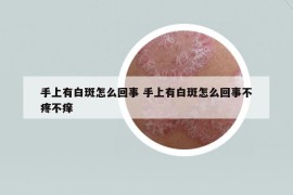 手上有白斑怎么回事 手上有白斑怎么回事不疼不痒