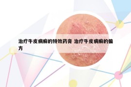 治疗牛皮病癣的特效药膏 治疗牛皮病癣的偏方