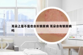 耳朵上是不是也会长银屑病 耳朵会有银屑病吗