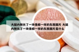 大腿内侧长了一块像癣一样的东西图片 大腿内侧长了一块像癣一样的东西图片是什么