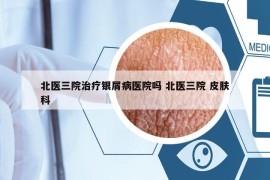北医三院治疗银屑病医院吗 北医三院 皮肤科