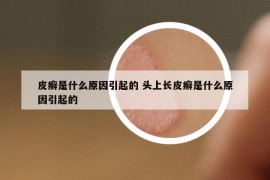 皮癣是什么原因引起的 头上长皮癣是什么原因引起的