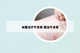 米醋治疗牛皮癣 醋治牛皮屑