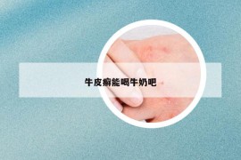 牛皮癣能喝牛奶吧