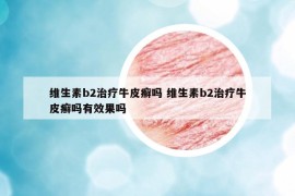 维生素b2治疗牛皮癣吗 维生素b2治疗牛皮癣吗有效果吗
