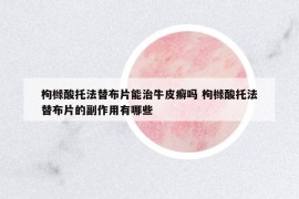 枸橼酸托法替布片能治牛皮癣吗 枸橼酸托法替布片的副作用有哪些