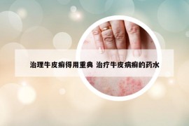 治理牛皮癣得用重典 治疗牛皮病癣的药水