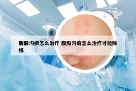 腹股沟癣怎么治疗 腹股沟癣怎么治疗才能除根