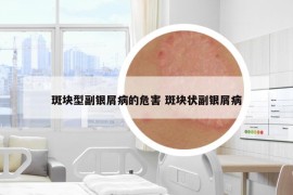 斑块型副银屑病的危害 斑块状副银屑病