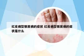 红皮病型银屑病的症状 红皮病型银屑病的症状是什么