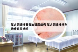 复方酮康唑乳膏治银屑病吗 复方酮康唑洗剂治疗银屑病吗