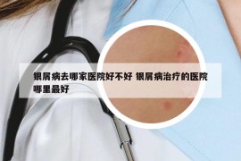 银屑病去哪家医院好不好 银屑病治疗的医院哪里最好